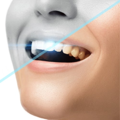 teeth whitening
