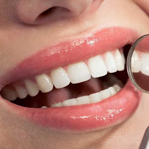 Teeth  reshaping