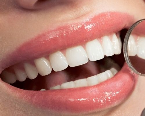 Teeth  reshaping